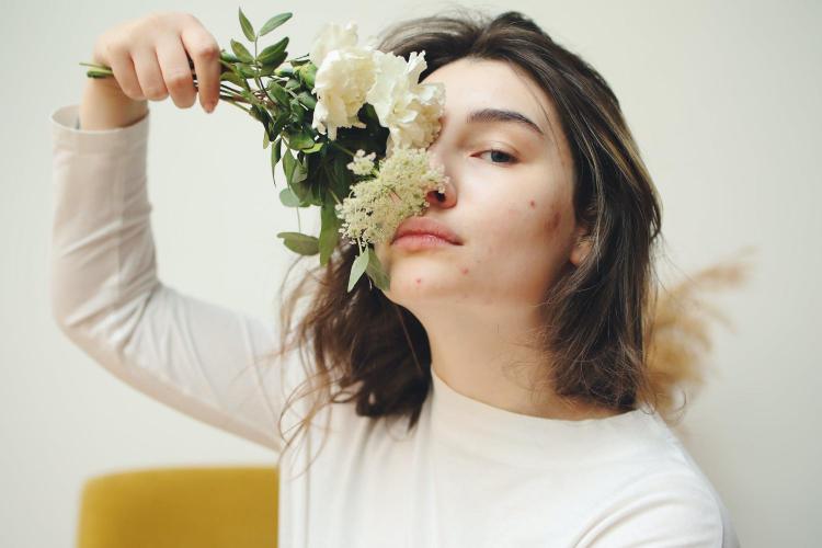A girl's face with acne