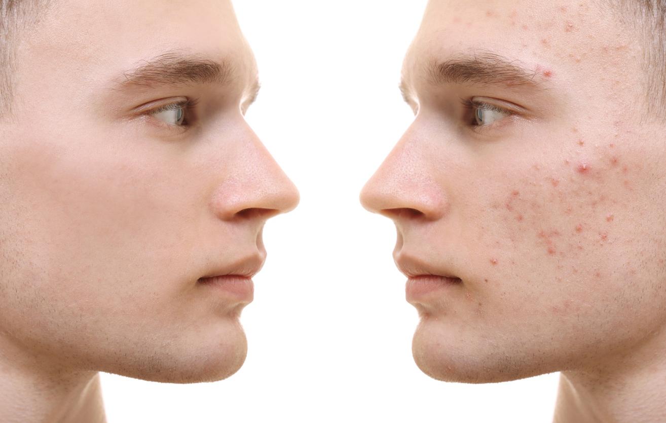 Comparison - showing the transformation of a face before and after acne treatment