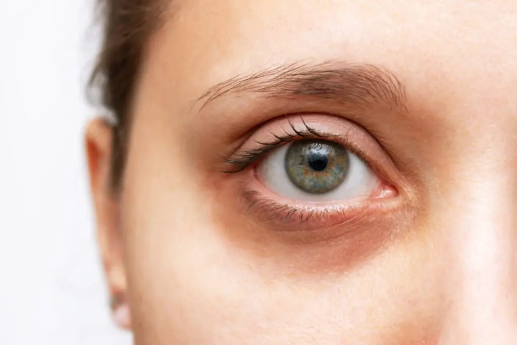 A close-up of a girl's eye, emphasizing dark circles
