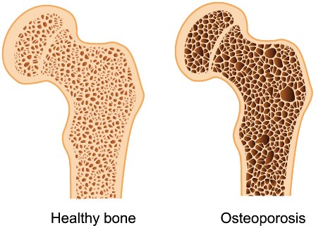 Comparing Knee Joints: One Illustrating Normal Health and the Other Affected by Osteoporosis