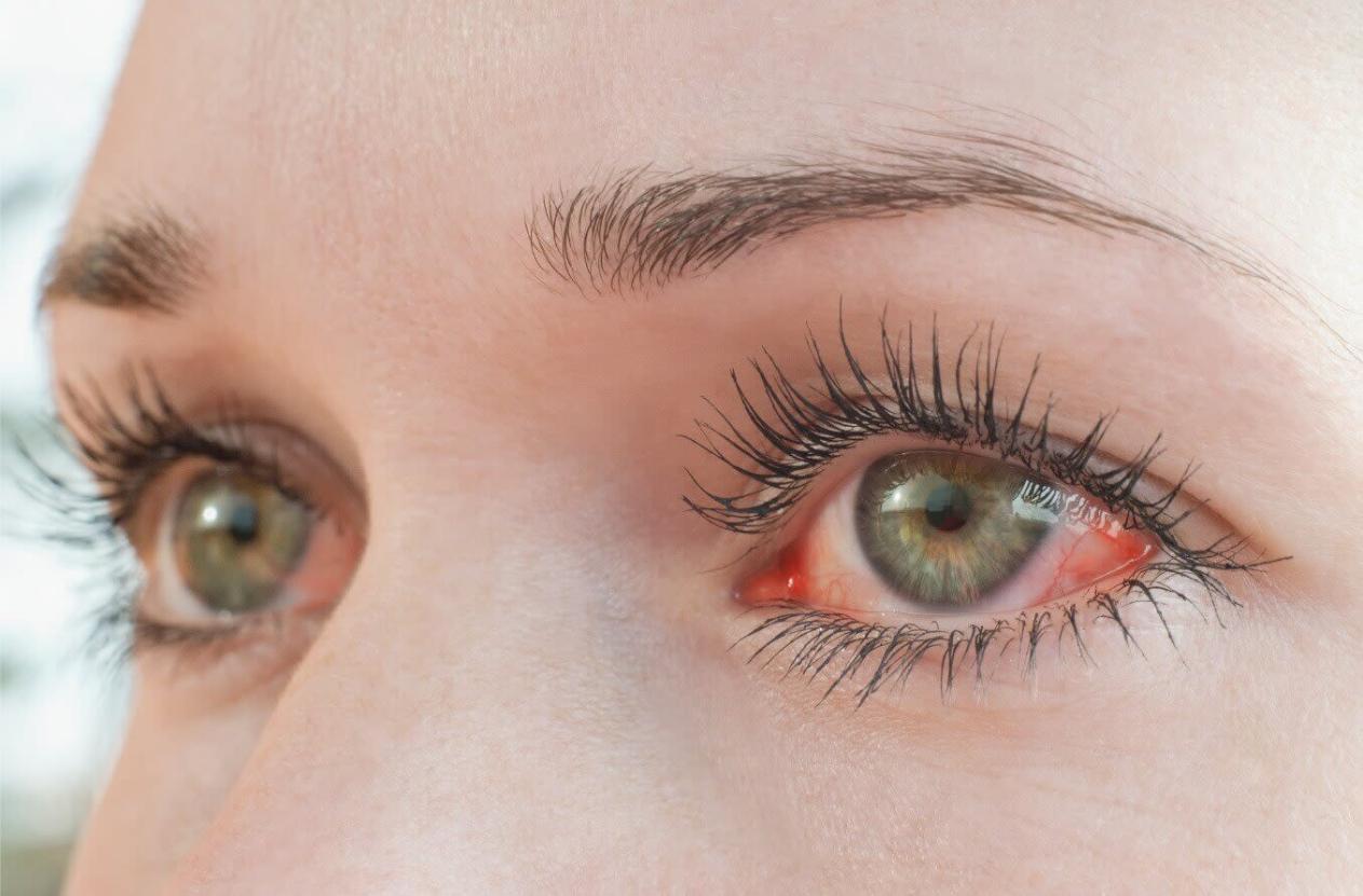 Photokeratitis eyes of a woman