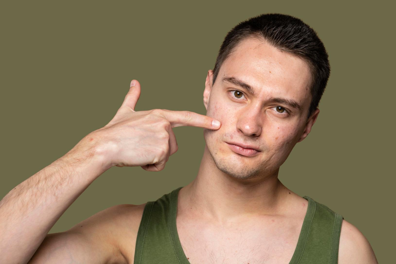 A young man pointing towards his face showing the acne