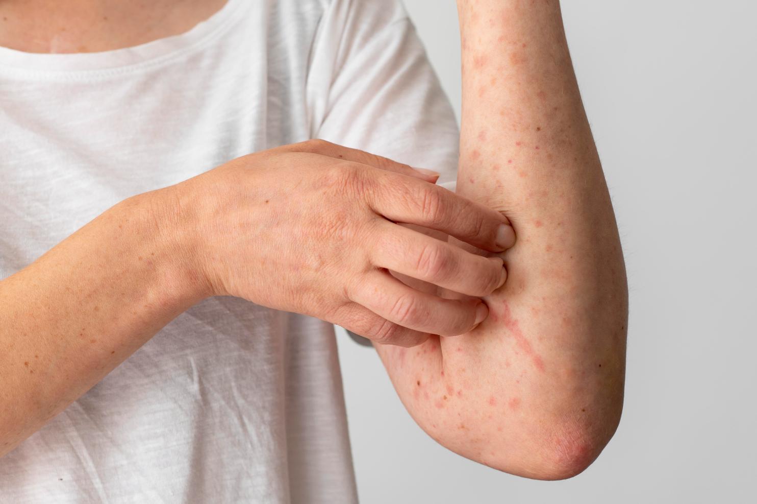 A person itching his allergic arm with his right hand 