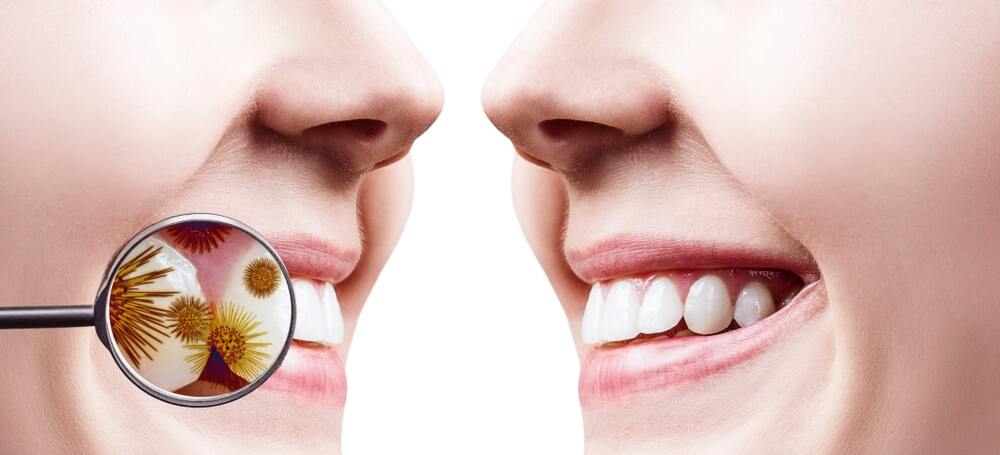 Close-up of a woman's healthy teeth - Close-up comparison showcasing the bacteria impacting teeth