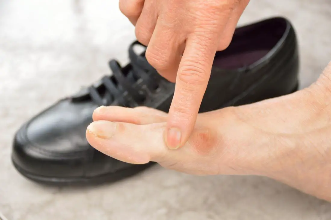 An elderly woman show a bunion, with a black shoe positioned on one side.