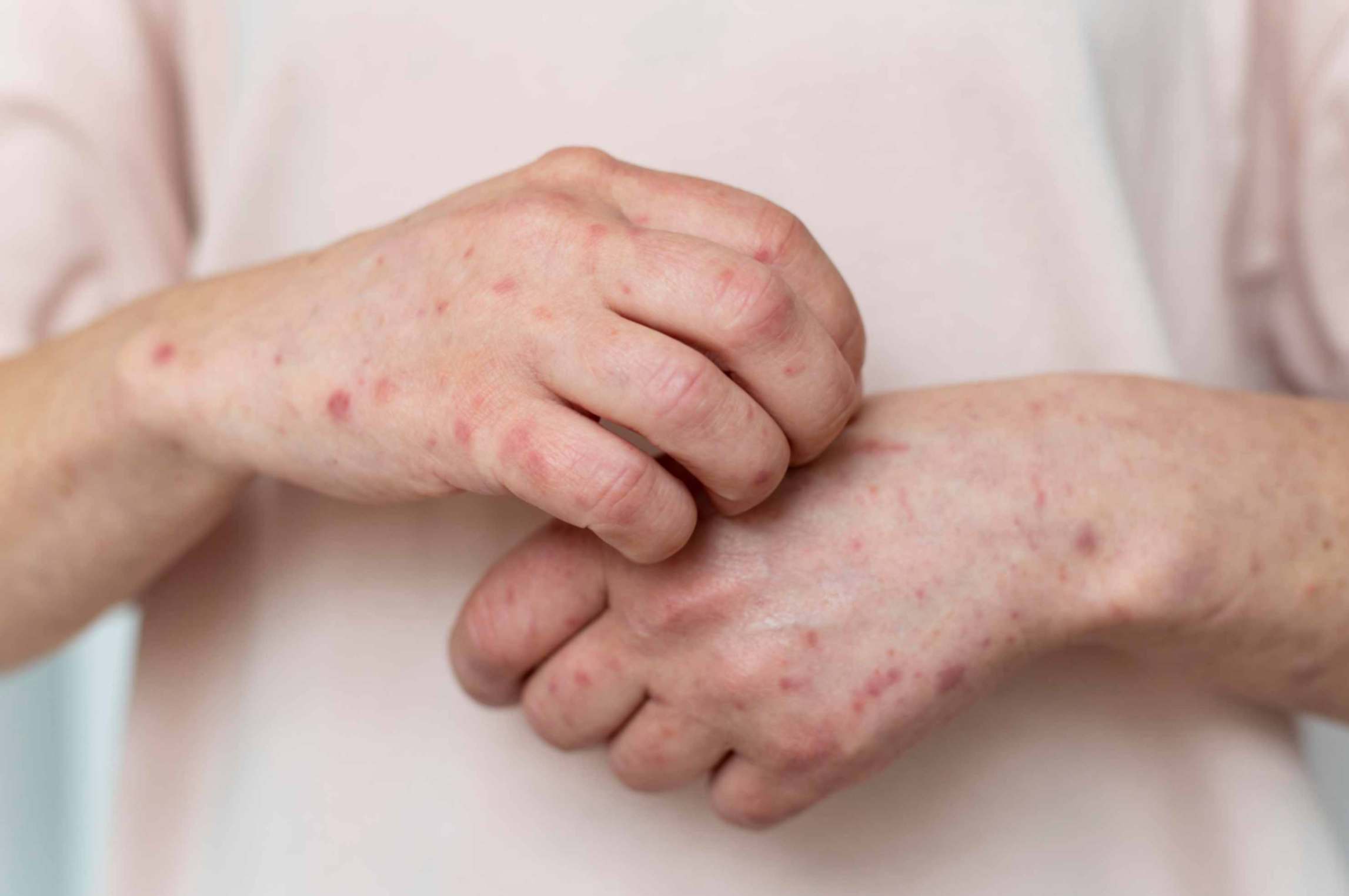Allergic arms of a woman suffering from psoriasis