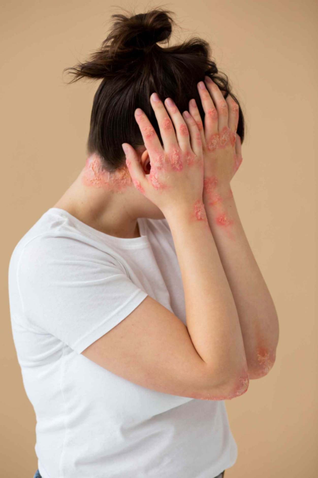 Woman suffering from psoriasis 