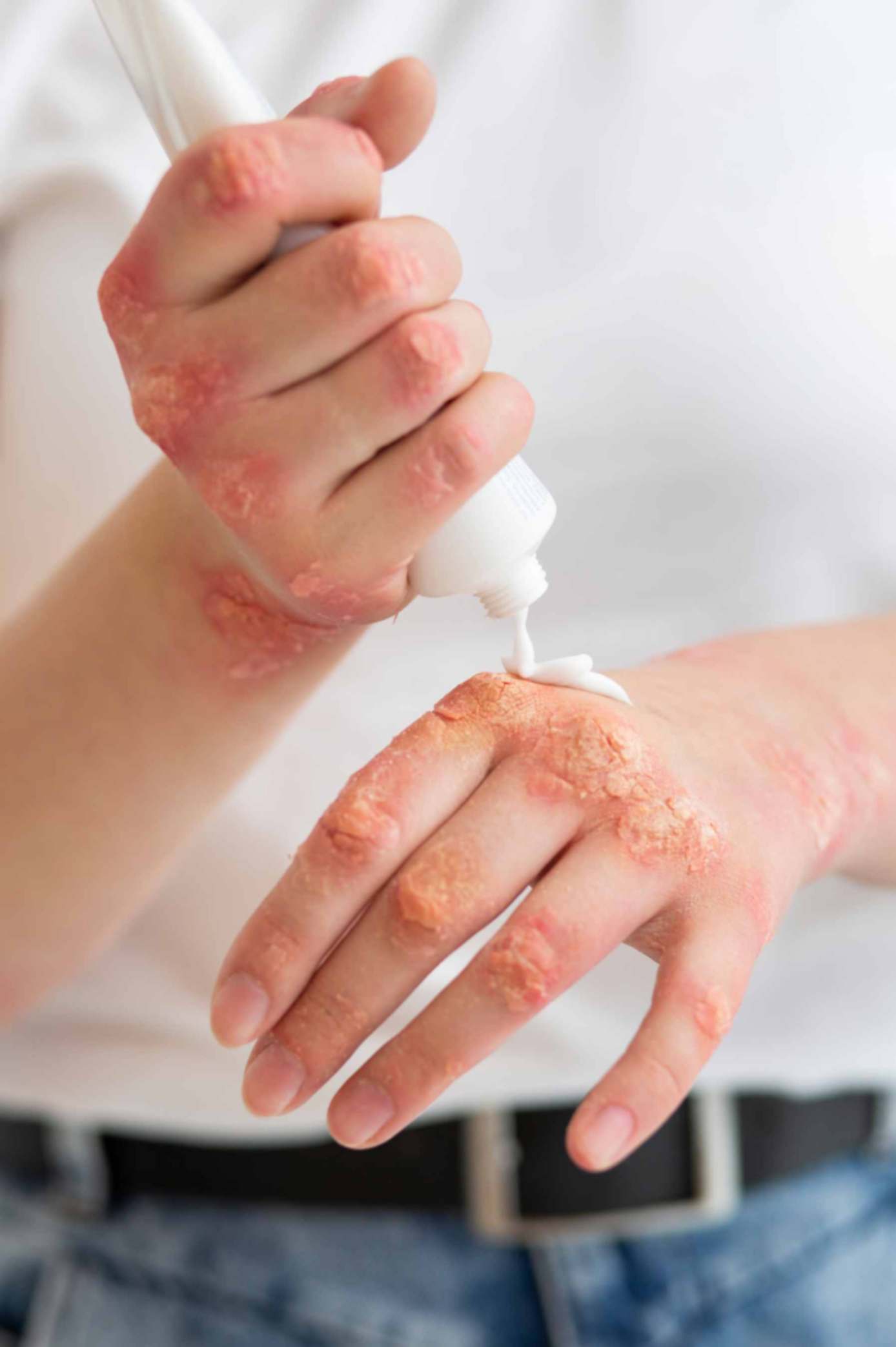a woman applying sunscreen on her hands affected by psoriasis
