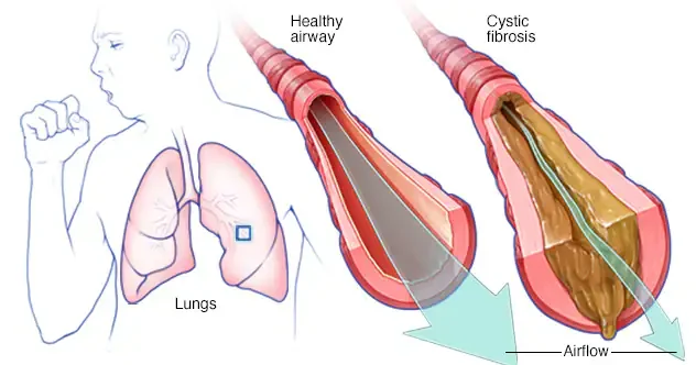 Diagram of a human coughing heavily with lungs exposed, showing magnification of their air passages. Comparison between a healthy airway and one affected by cystic fibrosis