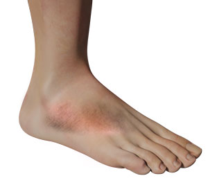 An inflamed foot