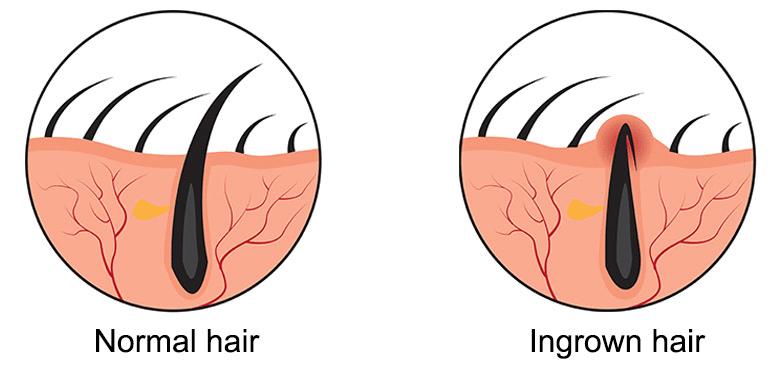 An illustration depicting ingrown hair compared to normal hair growth could show a side-by-side comparison. 