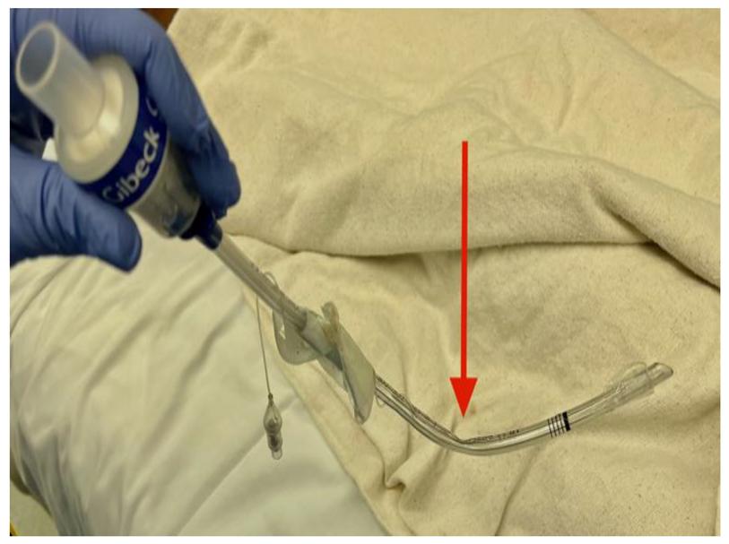 A Red Arrow Pointing towards Kinking or Compression of the Ventilator Tubing