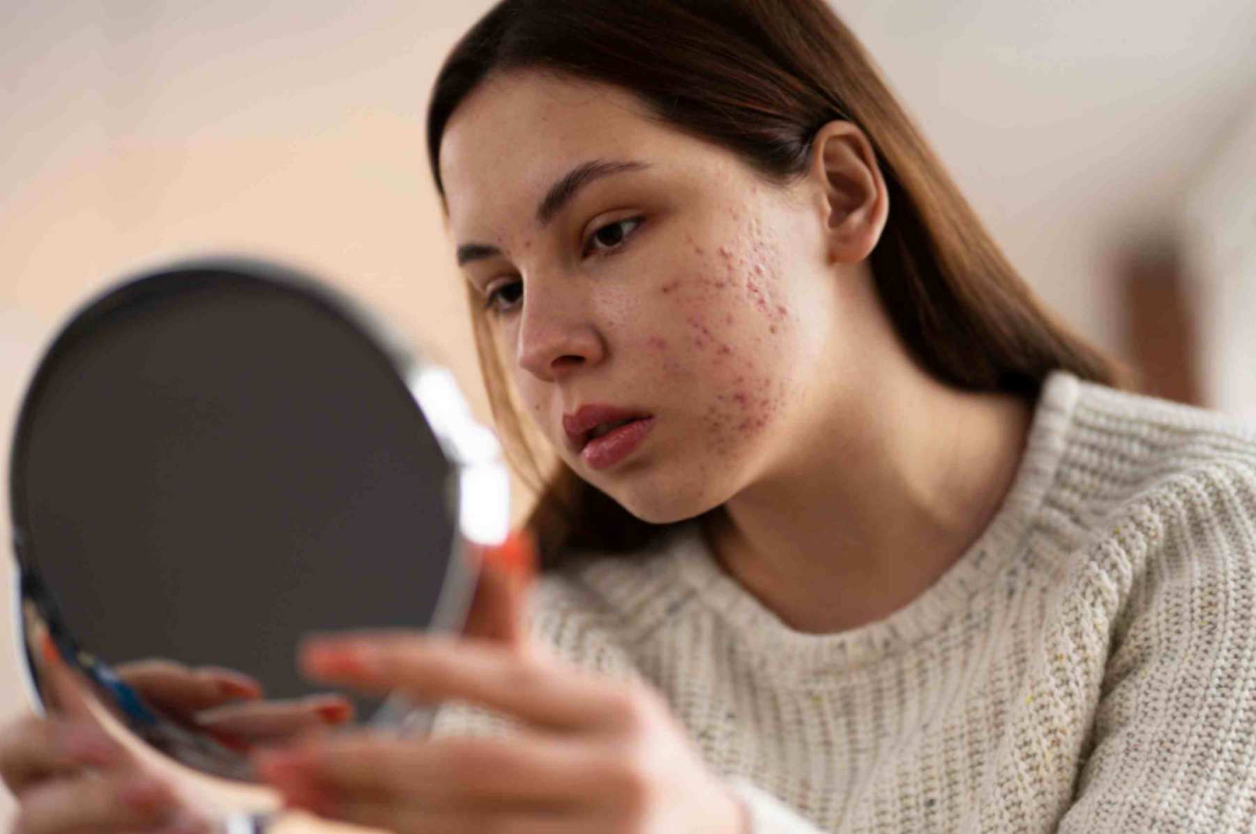Woman suffering from rosacea watching her face in mirror