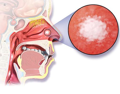 Anatomical diagram of a human illustrating nasal cancer